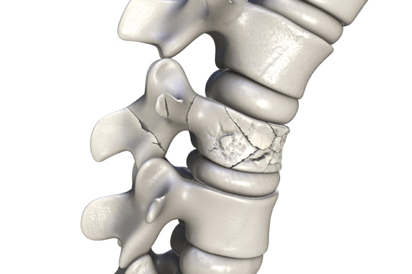 Spine Fractures – Causes, Symptoms, and Treatments in Kozhikode