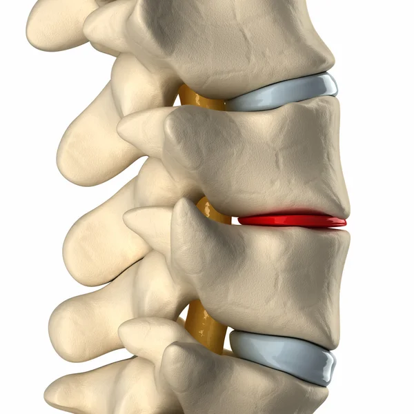Infective Spondylodiscitis at L5-S1