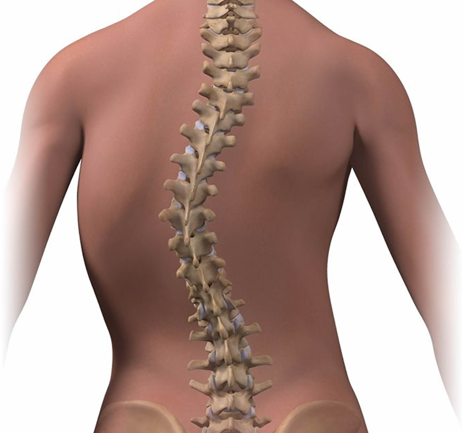 Adolescent Idiopathic Scoliosis