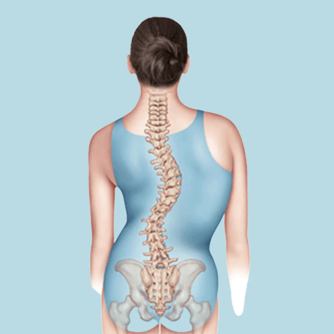 Severe Double Major Curve Scoliosis in Adolescent Female