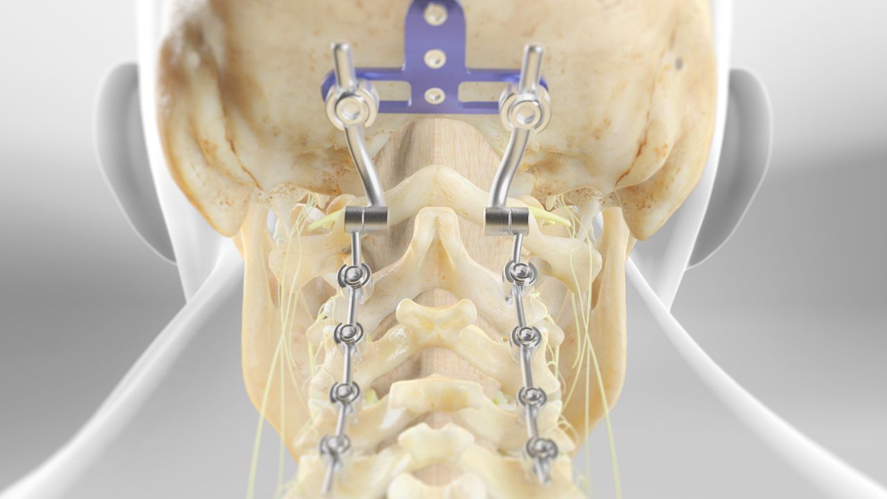 Occipito-Cervical Fusion detailed medical procedure