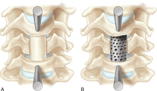 Cervical Copectomy detailed medical procedure