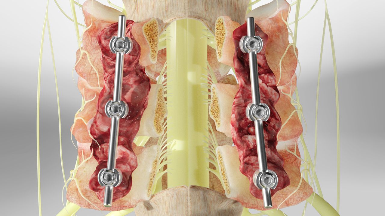 Posterior Cervical Laminectomy detailed medical procedure
